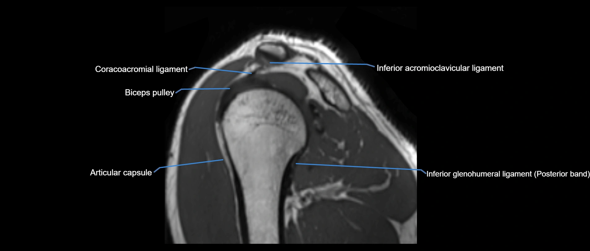 shoulder ligaments sagittal  cross sectional anatomy 3T MRI AI enhanced radiology image -img-00001-00040.webp